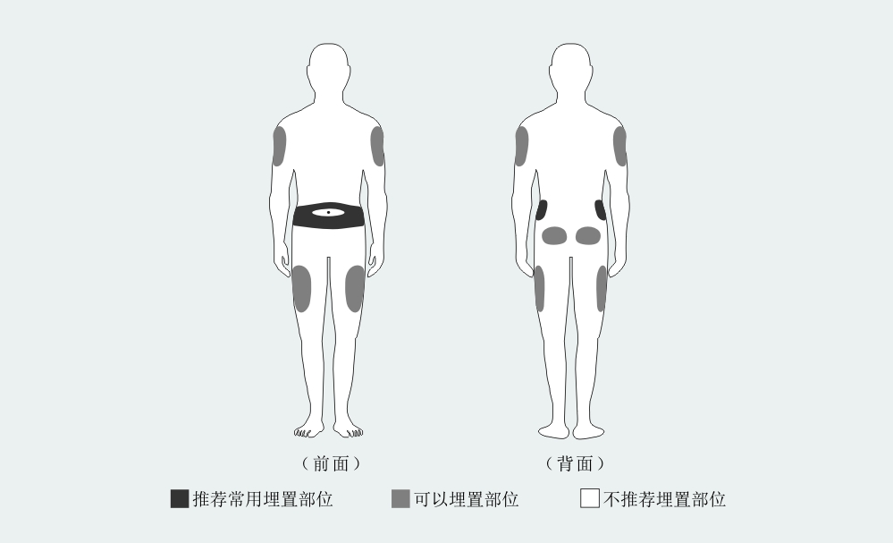 胰岛素泵常见问题解答